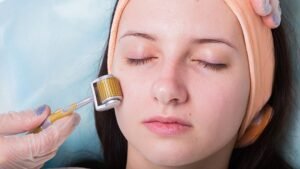 Answers To What Does Microneedling Do